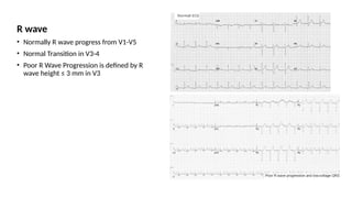 R wave
• Normally R wave progress from V1-V5
• Normal Transition in V3-4
• Poor R Wave Progression is defined by R
wave height ≤ 3 mm in V3
 