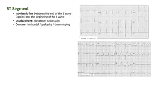 ST Segment
• Isoelectric line between the end of the S wave
(J point) and the beginning of the T wave
• Displacement: elevation/ depression
• Contour: horizontal /upsloping / downsloping
 