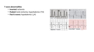 T wave abnormalities
• Inverted: ischemia
• Peaked: Early ischemia, hyperkalemia (↑K)
• Flat/U waves: hypokalemia (↓K)
 