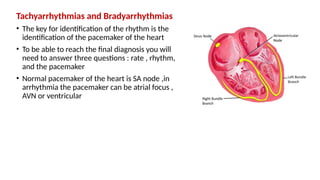 Tachyarrhythmias and Bradyarrhythmias
• The key for identification of the rhythm is the
identification of the pacemaker of the heart
• To be able to reach the final diagnosis you will
need to answer three questions : rate , rhythm,
and the pacemaker
• Normal pacemaker of the heart is SA node ,in
arrhythmia the pacemaker can be atrial focus ,
AVN or ventricular
 