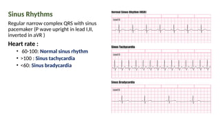Sinus Rhythms
Regular narrow complex QRS with sinus
pacemaker (P wave upright in lead I,II,
inverted in aVR )
Heart rate :
• 60-100: Normal sinus rhythm
• >100 : Sinus tachycardia
• <60: Sinus bradycardia
 