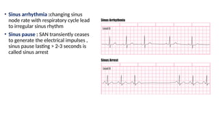 • Sinus arrhythmia :changing sinus
node rate with respiratory cycle lead
to irregular sinus rhythm
• Sinus pause : SAN transiently ceases
to generate the electrical impulses ,
sinus pause lasting > 2-3 seconds is
called sinus arrest
 