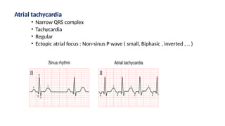 Atrial tachycardia
• Narrow QRS complex
• Tachycardia
• Regular
• Ectopic atrial focus : Non-sinus P wave ( small, Biphasic , inverted , .. )
 