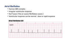 Atrial fibrillation
• Narrow QRS complex
• Irregular ventricular response
• No P wave ( fine or coarse fibrillatory waves )
• Ventricular response can be normal , slow or rapid response
 