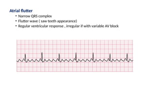 Atrial flutter
• Narrow QRS complex
• Flutter wave ( saw teeth appearance)
• Regular ventricular response , irregular if with variable AV block
 