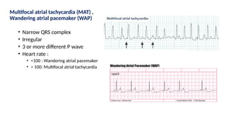 Multifocal atrial tachycardia (MAT) ,
Wandering atrial pacemaker (WAP)
• Narrow QRS complex
• Irregular
• 3 or more different P wave
• Heart rate :
• <100 : Wandering atrial pacemaker
• > 100: Multifocal atrial tachycardia
 