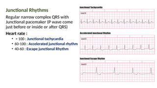 Junctional Rhythms
Regular narrow complex QRS with
Junctional pacemaker (P wave come
just before or inside or after QRS)
Heart rate :
• > 100 : Junctional tachycardia
• 60-100 : Accelerated junctional rhythm
• 40-60 : Escape junctional Rhythm
 