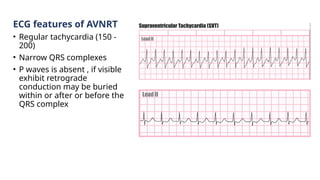 ECG features of AVNRT
• Regular tachycardia (150 -
200)
• Narrow QRS complexes
• P waves is absent , if visible
exhibit retrograde
conduction may be buried
within or after or before the
QRS complex
 
