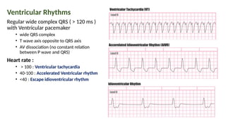 Ventricular Rhythms
Regular wide complex QRS ( > 120 ms )
with Ventricular pacemaker
• wide QRS complex
• T wave axis opposite to QRS axis
• AV dissociation (no constant relation
between P wave and QRS)
Heart rate :
• > 100 : Ventricular tachycardia
• 40-100 : Accelerated Ventricular rhythm
• <40 : Escape idioventricular rhythm
 