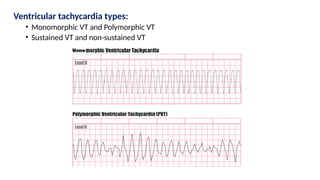 Ventricular tachycardia types:
• Monomorphic VT and Polymorphic VT
• Sustained VT and non-sustained VT
 