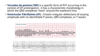 • Torsades de pointes (TdP) is a specific form of PVT occurring in the
context of QT prolongation , it has a characteristic morphology in
which the QRS complexes “twist” around the isoelectric line.
• Ventricular Fibrillation (VF) : Chaotic irregular deflections of varying
amplitude with no identifiable P waves, QRS complexes, or T waves.
 