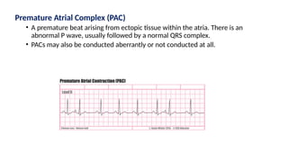Premature Atrial Complex (PAC)
• A premature beat arising from ectopic tissue within the atria. There is an
abnormal P wave, usually followed by a normal QRS complex.
• PACs may also be conducted aberrantly or not conducted at all.
 