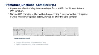 Premature Junctional Complex (PJC)
• A premature beat arising from an ectopic focus within the Atrioventricular
(AV) junction.
• Narrow QRS complex, either without a preceding P wave or with a retrograde
P wave which may appear before, during, or after the QRS complex
 