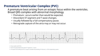 Premature Ventricular Complex (PVC)
A premature beat arising from an ectopic focus within the ventricles.
Broad QRS complex with abnormal morphology
• Premature : occurs earlier than would be expected.
• Discordant ST segment and T wave changes.
• Usually followed by a full compensatory pause.
• Retrograde capture of the atria may or may not occur.
 