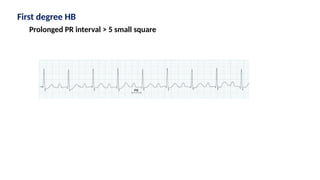 First degree HB
Prolonged PR interval > 5 small square
 