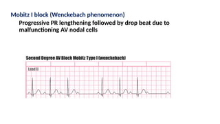 Mobitz I block (Wenckebach phenomenon)
Progressive PR lengthening followed by drop beat due to
malfunctioning AV nodal cells
 
