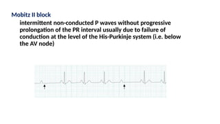 Mobitz II block
intermittent non-conducted P waves without progressive
prolongation of the PR interval usually due to failure of
conduction at the level of the His-Purkinje system (i.e. below
the AV node)
 