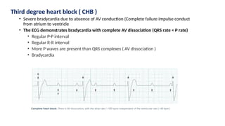 Third degree heart block ( CHB )
• Severe bradycardia due to absence of AV conduction (Complete failure impulse conduct
from atrium to ventricle
• The ECG demonstrates bradycardia with complete AV dissociation (QRS rate < P rate)
• Regular P-P interval
• Regular R-R interval
• More P waves are present than QRS complexes ( AV dissociation )
• Bradycardia
 