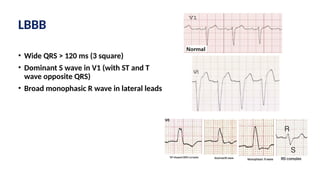 LBBB
• Wide QRS > 120 ms (3 square)
• Dominant S wave in V1 (with ST and T
wave opposite QRS)
• Broad monophasic R wave in lateral leads
 