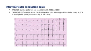 Intraventricular conduction delay
• Wide QRS but the pattern is not consistent with RBBB or LBBB .
• Can be due to fascicular block , Cardiomyopathy , LVH , Electrolyte abnormally , drugs as TCA
or Non-specific IVCD ( not due to any of the cause )
 