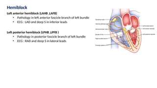 Hemiblock
Left anterior hemiblock (LAHB ,LAFB)
• Pathology in left anterior fascicle branch of left bundle
• ECG : LAD and deep S in inferior leads
Left posterior hemiblock (LPHB ,LPFB )
• Pathology in posterior fascicle branch of left bundle
• ECG : RAD and deep S in lateral leads
 