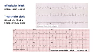 Bifascicular block
RBBB + LAHB or LPHB
Trifascicular block
Bifascicular block +
First degree AV block
 