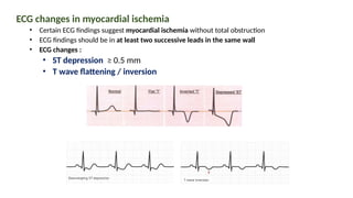 ECG changes in myocardial ischemia
• Certain ECG findings suggest myocardial ischemia without total obstruction
• ECG findings should be in at least two successive leads in the same wall
• ECG changes :
• ST depression ≥ 0.5 mm
• T wave flattening / inversion
 