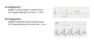 LA enlargement :
Lead II : P mitrale, broad +- notched P wave
V1 : Negative deflection of P wave > 1*1mm
RA enlargement :
Lead II: P pulmonale ,Tall and peaked P wave
V1 : Positive deflection of P wave is tall > 1 mm
 