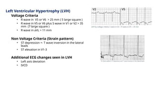 Left Ventricular Hypertrophy (LVH)
Voltage Criteria
• R wave in V5 or V6 > 25 mm ( 5 large square )
• R wave in V5 or V6 plus S wave in V1 or V2 > 35
mm (7 large square )
• R wave in aVL > 11 mm
Non Voltage Criteria (Strain pattern)
• ST depression +- T wave inversion in the lateral
leads
• ST elevation in V1-3
Additional ECG changes seen in LVH
• Left axis deviation
• IVCD
 
