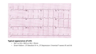 Typical appearance of LVH:
• S(V1 or V2) + R(V5 or V6) > 35mm
• Strain Pattern : ST Elevation V1-4 , ST Depression / Inverted T waves V5 and V6
 
