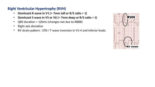 Right Ventricular Hypertrophy (RVH)
• Dominant R wave in V1 (> 7mm tall or R/S ratio > 1)
• Dominant S wave in V5 or V6 (> 7mm deep or R/S ratio < 1)
• QRS duration < 120ms (changes not due to RBBB)
• Right axis deviation
• RV strain pattern : STD / T wave inversion in V1-4 and inferior leads.
 