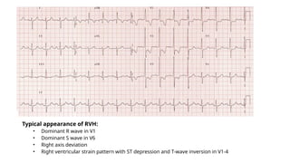 Typical appearance of RVH:
• Dominant R wave in V1
• Dominant S wave in V6
• Right axis deviation
• Right ventricular strain pattern with ST depression and T-wave inversion in V1-4
 