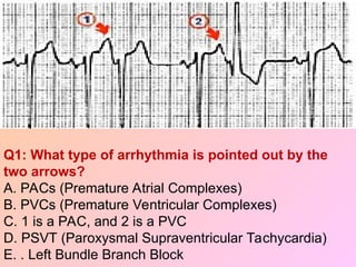 Q1: What type of arrhythmia is pointed out by the
two arrows?
A. PACs (Premature Atrial Complexes)
B. PVCs (Premature Ventricular Complexes)
C. 1 is a PAC, and 2 is a PVC
D. PSVT (Paroxysmal Supraventricular Tachycardia)
E. . Left Bundle Branch Block
 