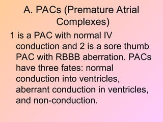 A. PACs (Premature Atrial
Complexes)
1 is a PAC with normal IV
conduction and 2 is a sore thumb
PAC with RBBB aberration. PACs
have three fates: normal
conduction into ventricles,
aberrant conduction in ventricles,
and non-conduction.
 