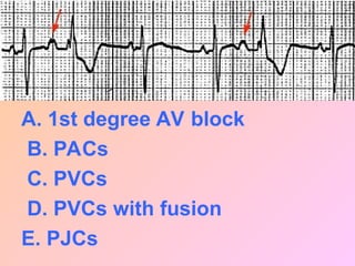 A. 1st degree AV block
B. PACs
C. PVCs
D. PVCs with fusion
E. PJCs
 