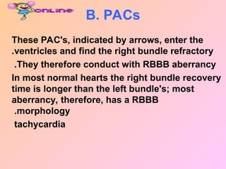 B. PACs
These PAC's, indicated by arrows, enter the
ventricles and find the right bundle refractory
.
They therefore conduct with RBBB aberrancy
.
In most normal hearts the right bundle recovery
time is longer than the left bundle's; most
aberrancy, therefore, has a RBBB
morphology
.
tachycardia
 