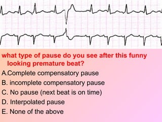 what type of pause do you see after this funny
looking premature beat?
A.Complete compensatory pause
B. incomplete compensatory pause
C. No pause (next beat is on time)
D. Interpolated pause
E. None of the above
 