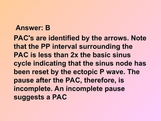 Answer: B
PAC's are identified by the arrows. Note
that the PP interval surrounding the
PAC is less than 2x the basic sinus
cycle indicating that the sinus node has
been reset by the ectopic P wave. The
pause after the PAC, therefore, is
incomplete. An incomplete pause
suggests a PAC
 