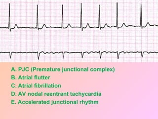 A. PJC (Premature junctional complex)
B. Atrial flutter
C. Atrial fibrillation
D. AV nodal reentrant tachycardia
E. Accelerated junctional rhythm
 