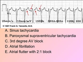 A. Sinus tachycardia
B. Paroxysmal supraventricular tachycardia
C. 3rd degree AV block
D. Atrial fibrillation
E. Atrial flutter with 2:1 block
 