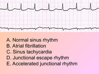 A. Normal sinus rhythm
B. Atrial fibrillation
C. Sinus tachycardia
D. Junctional escape rhythm
E. Accelerated junctional rhythm
 