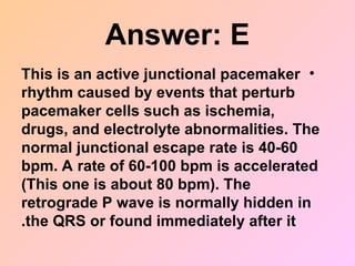 Answer: E
•
This is an active junctional pacemaker
rhythm caused by events that perturb
pacemaker cells such as ischemia,
drugs, and electrolyte abnormalities. The
normal junctional escape rate is 40-60
bpm. A rate of 60-100 bpm is accelerated
(This one is about 80 bpm). The
retrograde P wave is normally hidden in
the QRS or found immediately after it
.
 
