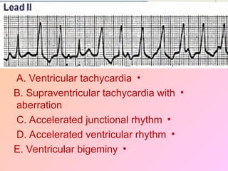 •
A. Ventricular tachycardia
•
B. Supraventricular tachycardia with
aberration
•
C. Accelerated junctional rhythm
•
D. Accelerated ventricular rhythm
•
E. Ventricular bigeminy
 