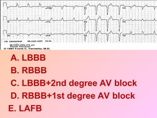 A. LBBB
B. RBBB
C. LBBB+2nd degree AV block
D. RBBB+1st degree AV block
E. LAFB
 