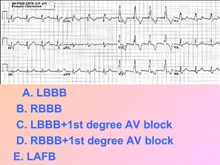 A. LBBB
B. RBBB
C. LBBB+1st degree AV block
D. RBBB+1st degree AV block
E. LAFB
 