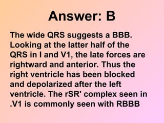Answer: B
The wide QRS suggests a BBB.
Looking at the latter half of the
QRS in I and V1, the late forces are
rightward and anterior. Thus the
right ventricle has been blocked
and depolarized after the left
ventricle. The rSR' complex seen in
V1 is commonly seen with RBBB
.
 