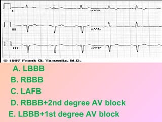 A. LBBB
B. RBBB
C. LAFB
D. RBBB+2nd degree AV block
E. LBBB+1st degree AV block
 
