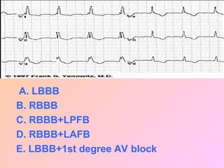 A. LBBB
B. RBBB
C. RBBB+LPFB
D. RBBB+LAFB
E. LBBB+1st degree AV block
 