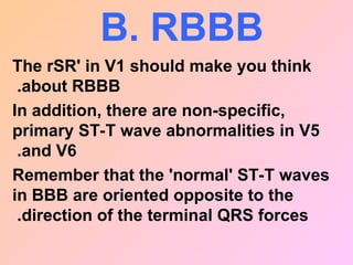 B. RBBB
The rSR' in V1 should make you think
about RBBB
.
In addition, there are non-specific,
primary ST-T wave abnormalities in V5
and V6
.
Remember that the 'normal' ST-T waves
in BBB are oriented opposite to the
direction of the terminal QRS forces
.
 