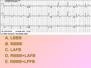 A. LBBB
B. RBBB
C. LAFB
D. RBBB+LAFB
E. RBBB+LPFB
 